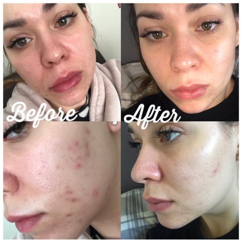 Ucenka The Inkey List Salicylic Acid Cleanser Gel Dlya Umyvaniya S Salicilovoj Kislotoj Sephora Cena 290 Grn Kupit Po Dostupnoj Cene Ukraina Shafa